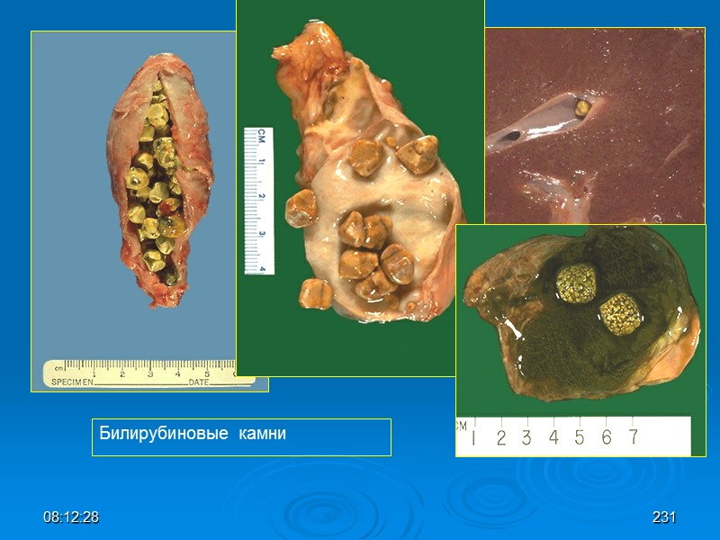 08:12:02 Билирубиновые камни 231